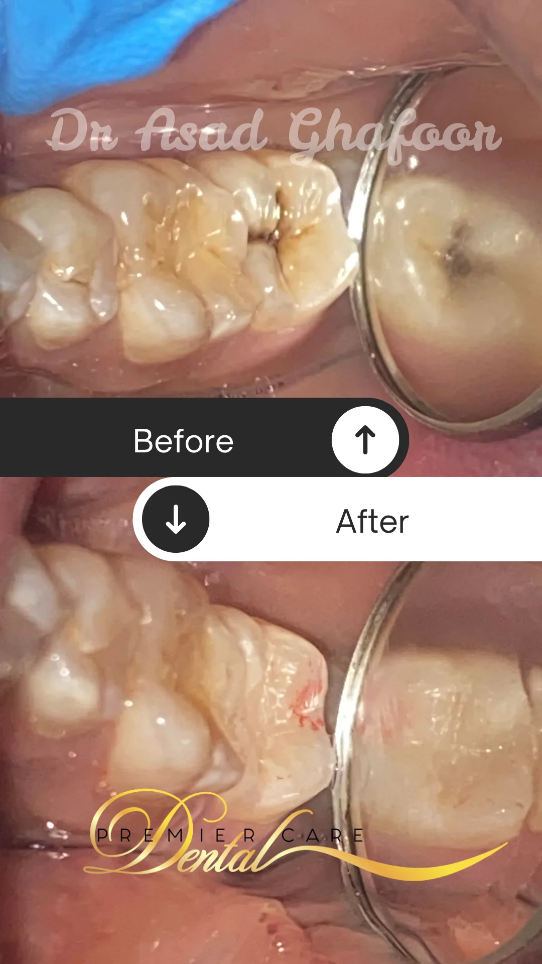 Step by step composite resin restorative dentistry overview at Premier Dental Care