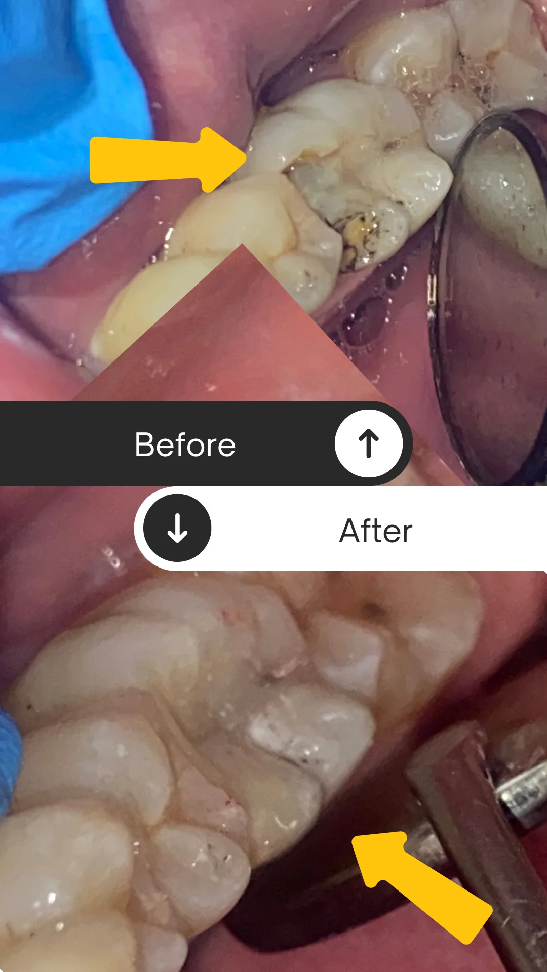 Direct aesthetic resin dental filling clinical procedure