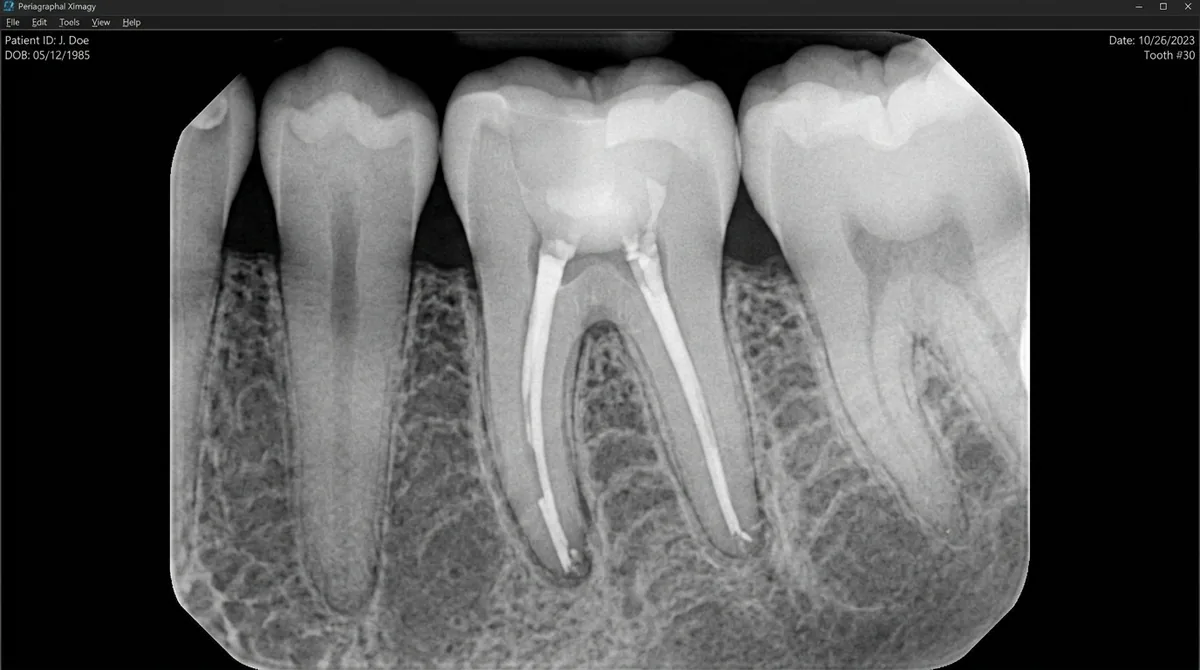 Endodontic therapy and tooth canal cleaning by Dr. Asad Ghafoor at Premier Dental Care