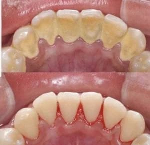 Clinical comparison of teeth before and after ultrasonic scaling treatment