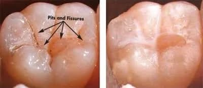 Pit and fissure sealants and preventive dentistry protecting enamel in Rahim Yar Khan